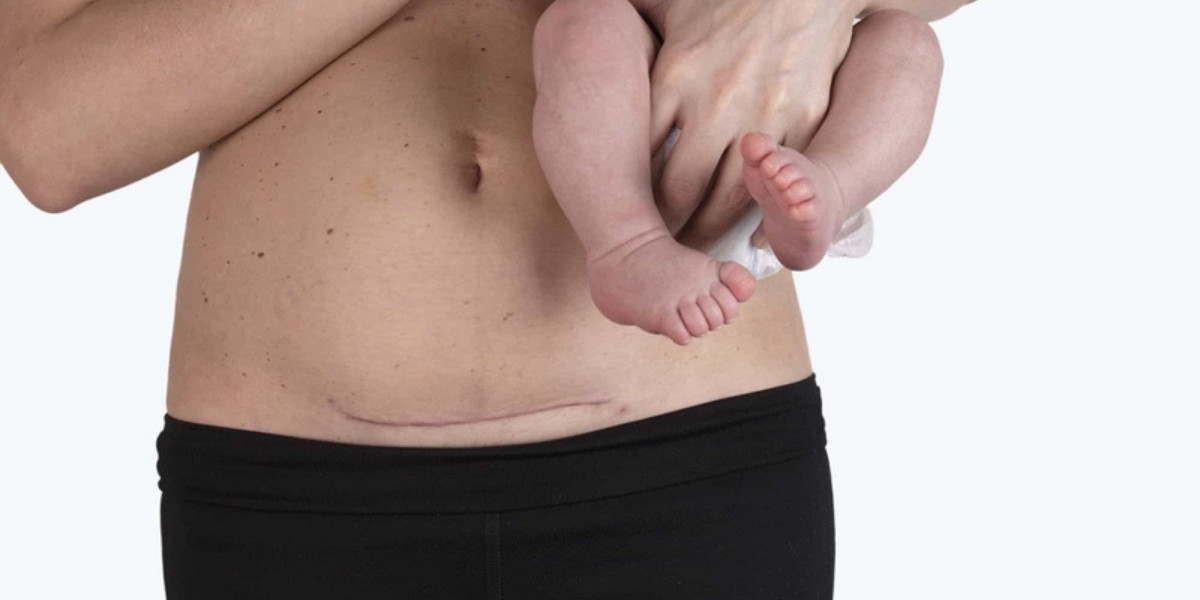 Vết mổ sau sinh bao lâu thì lành và giai đoạn hồi phục