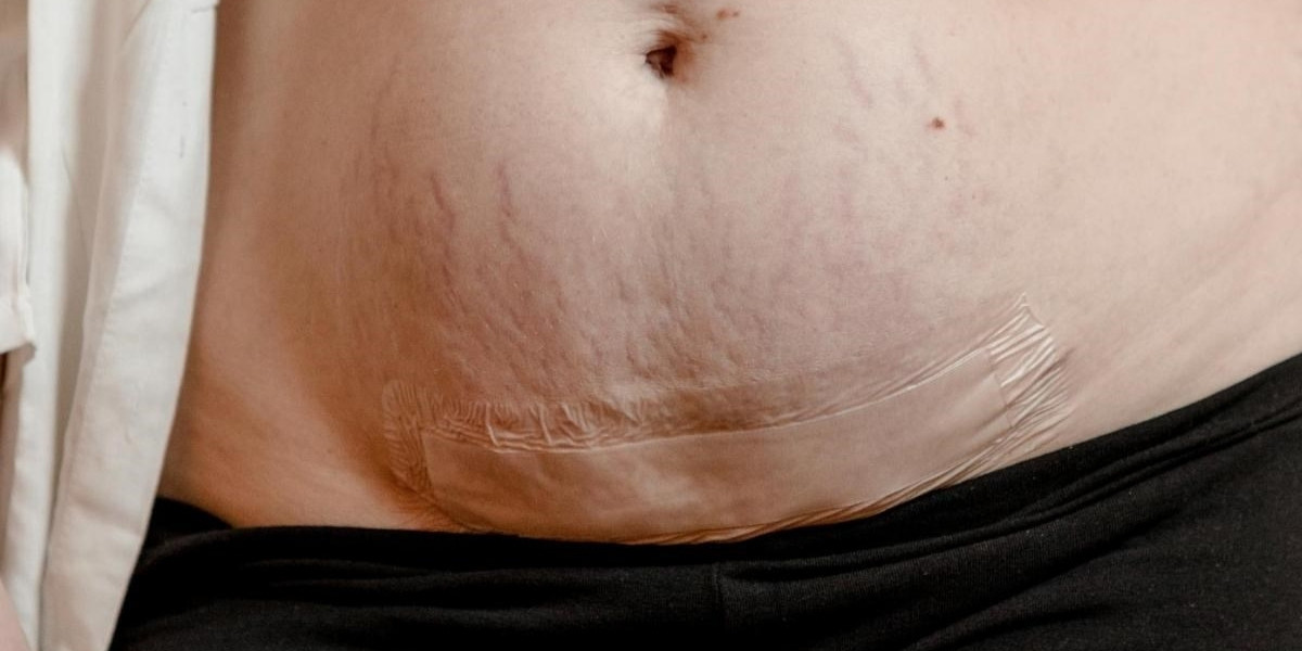 Vết mổ sau sinh và những thông tin quan trọng