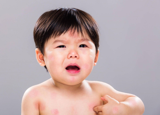 Trẻ bị nổi mẩn ngứa