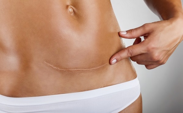 Giảm cân đối với các mẹ sinh mổ