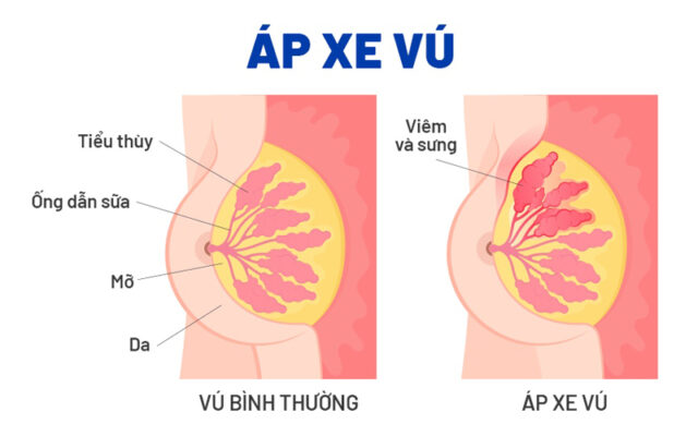 Tình trạng tắc tia sữa có thể tiến triển thành áp xe vú