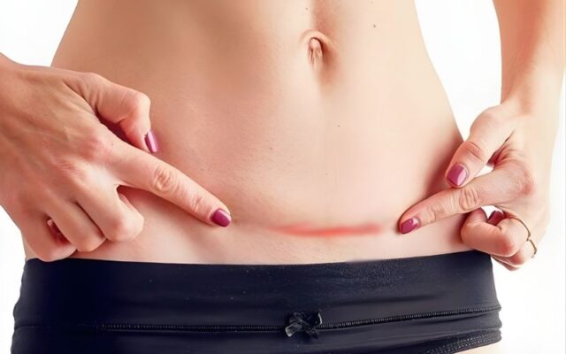 Vi khuẩn có thể xâm nhập qua vết mổ dẫn đến nhiễm khuẩn hậu sản