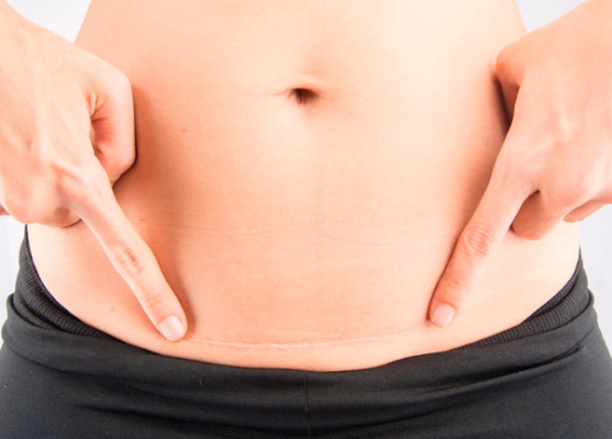 Nước dừa chứa axit lauric, kháng khuẩn, giúp vết mổ mau lành