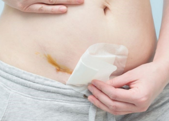 Thay băng sinh mổ sẽ ngăn ngừa nhiễm trùng và giữ sạch vết mổ