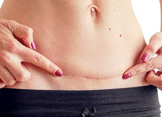 Vết mổ chưa lành cần nước để tránh nguy cơ nhiễm trùng