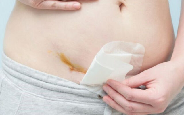 Chăm sóc vết mổ bị đỏ an toàn và nhanh lành