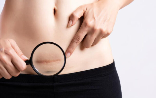 Dị ứng chỉ tự tiêu sau sinh