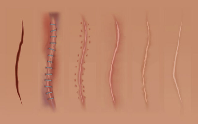 Thời gian khâu chỉ tự tiêu sau sinh bao lâu thì hết