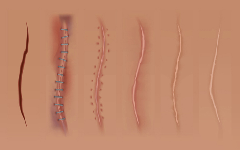 Thời gian khâu chỉ tự tiêu sau sinh bao lâu thì hết