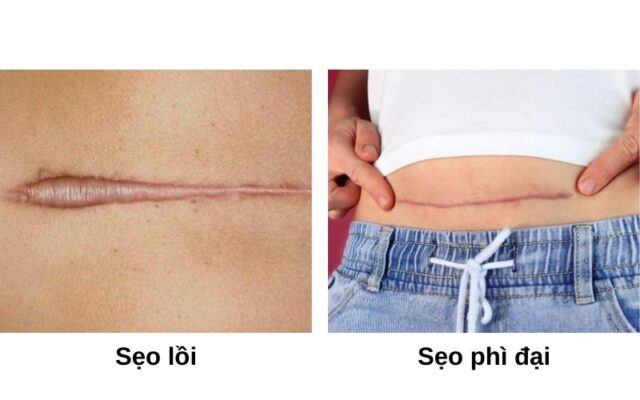 Sẹo lồi và sẹo phì đại