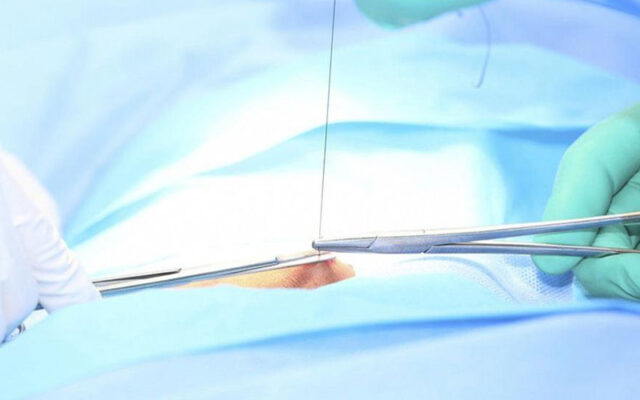 Thời gian tiêu chỉ phụ thuộc vào vị trí vết mổ