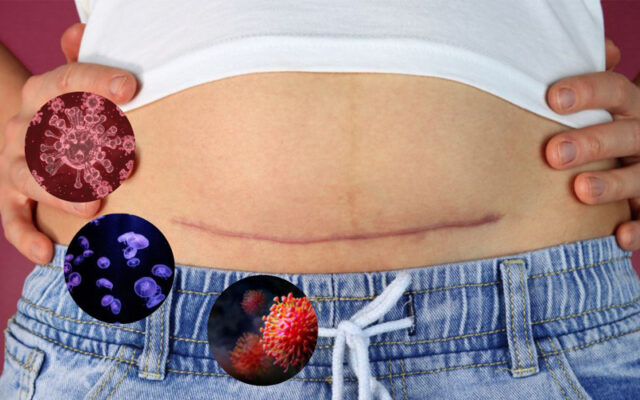 Vết mổ có thể bị nhiễm trùng