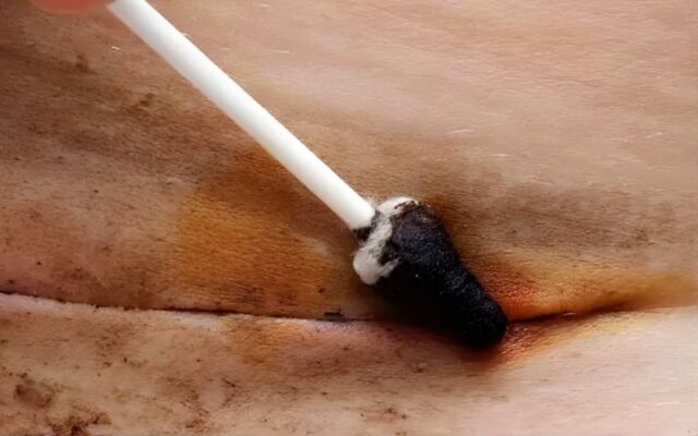 Vết mổ bị đỏ do dị ứng với chỉ khâu hoặc thuốc bôi