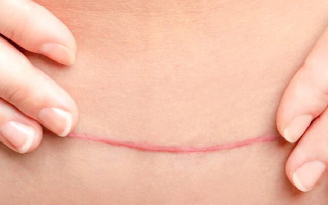 Vết mổ sau sinh bị đỏ có sao không?