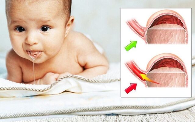 Trào ngược dạ dày là tình trạng thường gặp ở trẻ sơ sinh